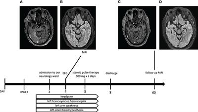 Case Report: Stroke-like migraine attacks after radiation therapy syndrome: a rare complication 26 years after cranial radiotherapy